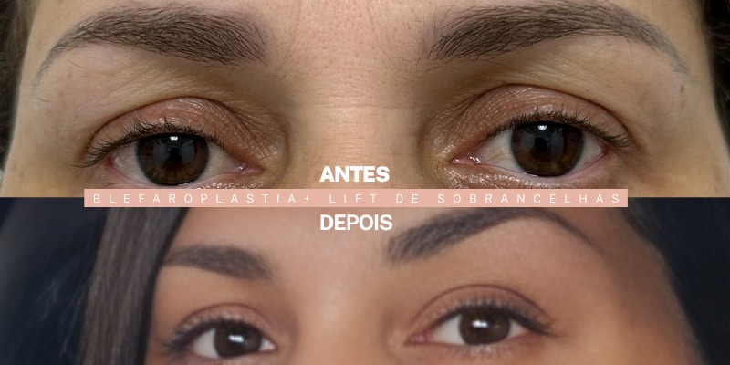 Antes e depois — blefaroplastia superior com lift de sobrancelhas, paciente da Dra. Ionne Darlen