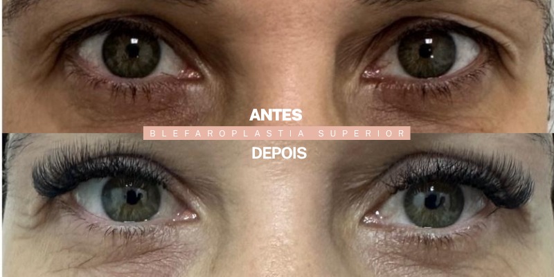 Antes e depois — blefaroplastia superior, paciente da Dra. Ionne Darlen