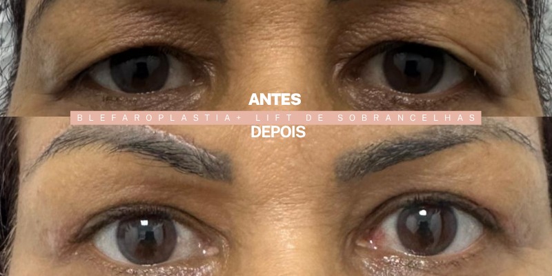 Antes e depois — blefaroplastia com lift de sobrancelhas, paciente da Dra. Ionne Darlen