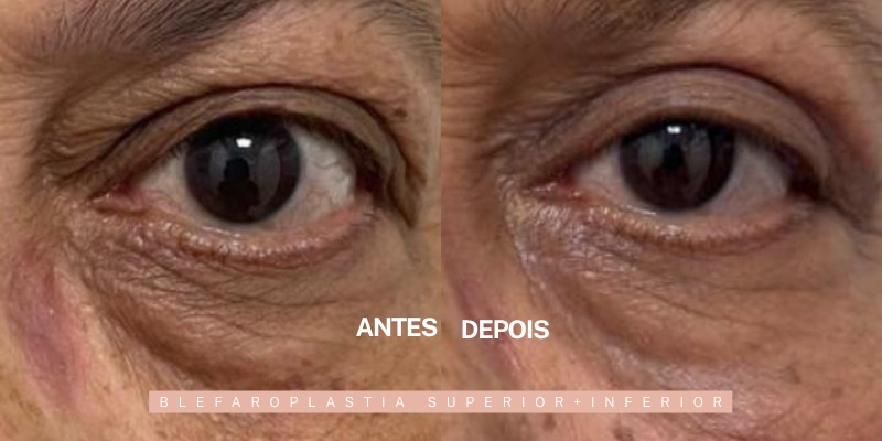 Antes e depois — blefaroplastia superior e inferior, paciente da Dra. Ionne Darlen