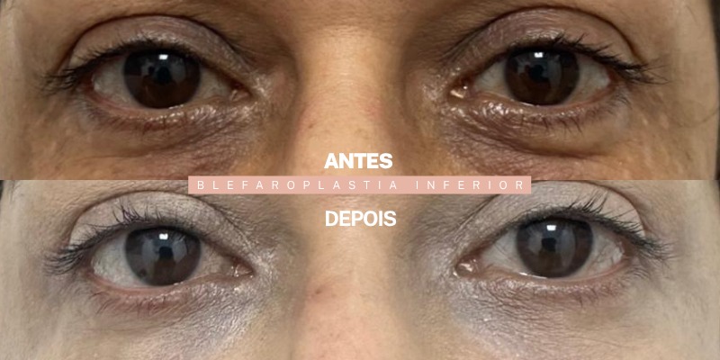 Antes e depois — blefaroplastia inferior, paciente da Dra. Ionne Darlen
