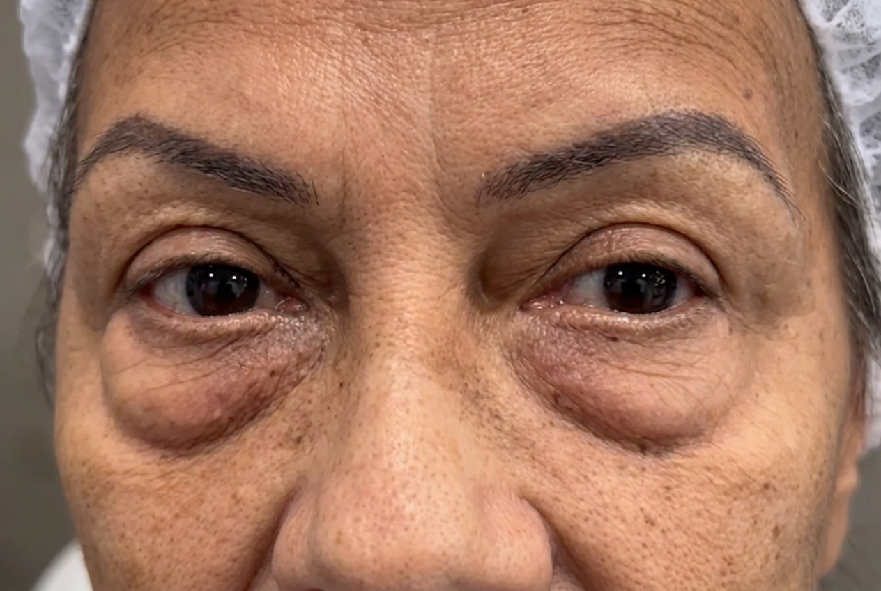 Detalhe da pálpebra inferior — área tratada na blefaroplastia inferior